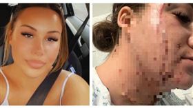 尼森頸部與臉部留下明顯疤痕，她坦言這段「父女戀」最終以悲劇收場，至今身心難以復原。（圖／Rosie Niessen提供）