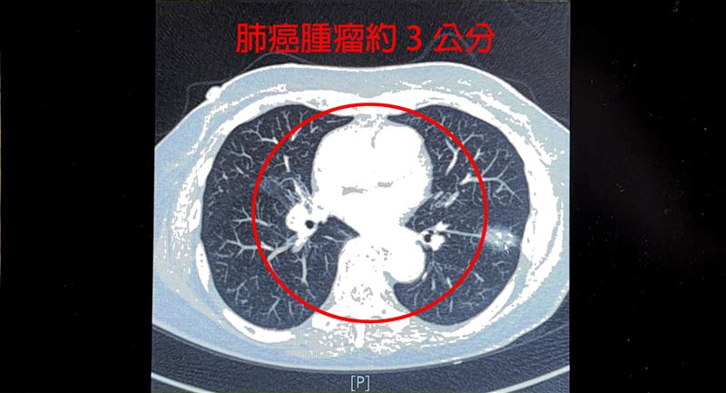 75歲婦人不菸不酒,卻因10多年前曾患肺結核種下病根。(圖/中醫大新竹附醫提供)