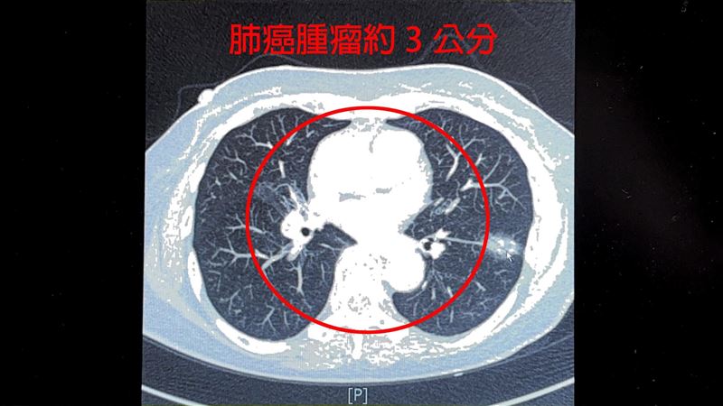 7旬婦不菸酒罹肺癌　竟和「1病」有關係