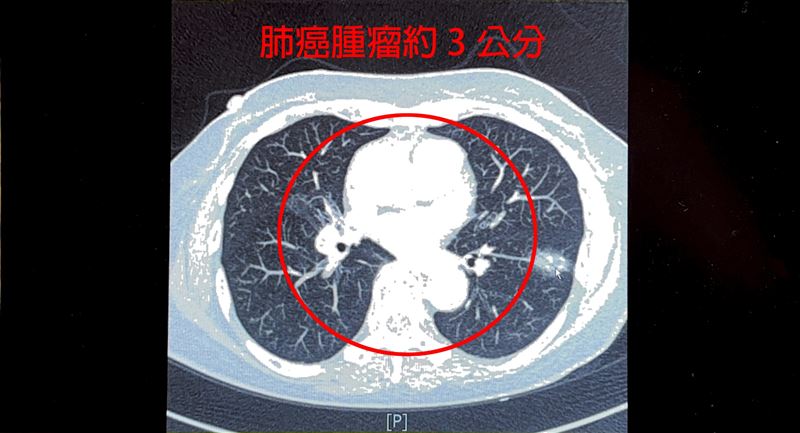 女患者左下肺葉有一顆接近3公分的惡性腫瘤。（圖／中國醫藥大學新竹附設醫院提供）