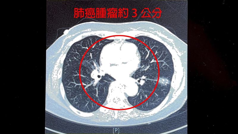 不菸不酒也中　「1病史」肺癌風險飆200倍