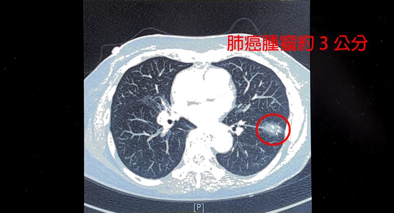 75歲婦人不菸不酒，卻因10多年前曾患肺結核種下病根。（圖／中醫大新竹附醫提供）