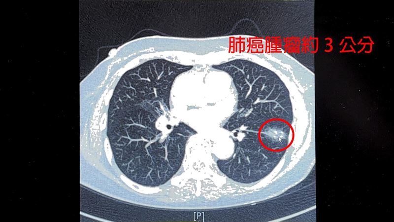 7旬婦不菸酒罹肺癌　竟和「1病」有關係