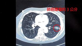 女患者左下肺葉有一顆接近3公分的惡性腫瘤。（圖／中國醫藥大學新竹附設醫院提供）