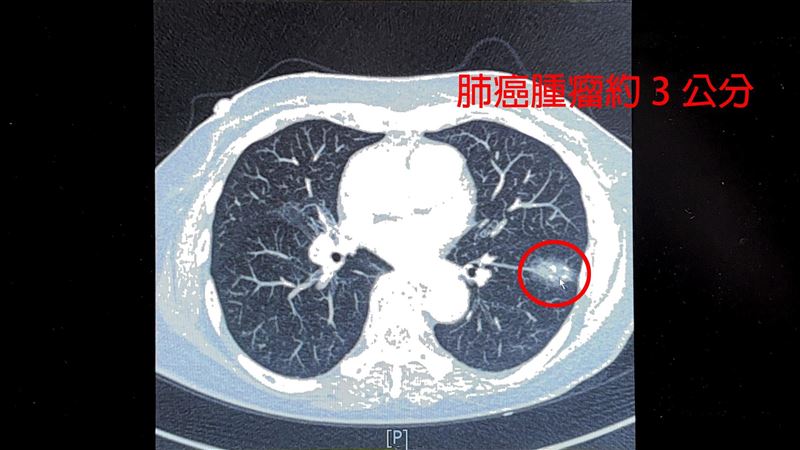 不菸不酒也中　「1病史」肺癌風險飆200倍
