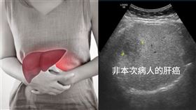 肝臟、肝癌、肝炎（合成圖／翻攝自pixabay、腹內的日常 吳宗勤醫師臉書）