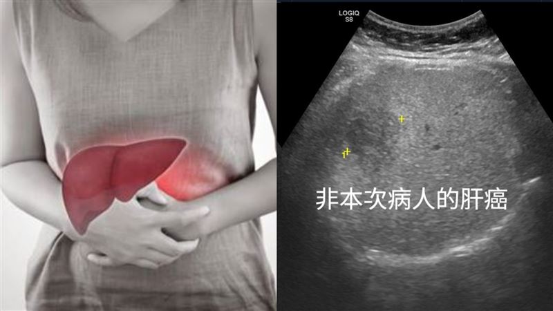 照超音波意外揪2公分肝癌　1高危族群小心
