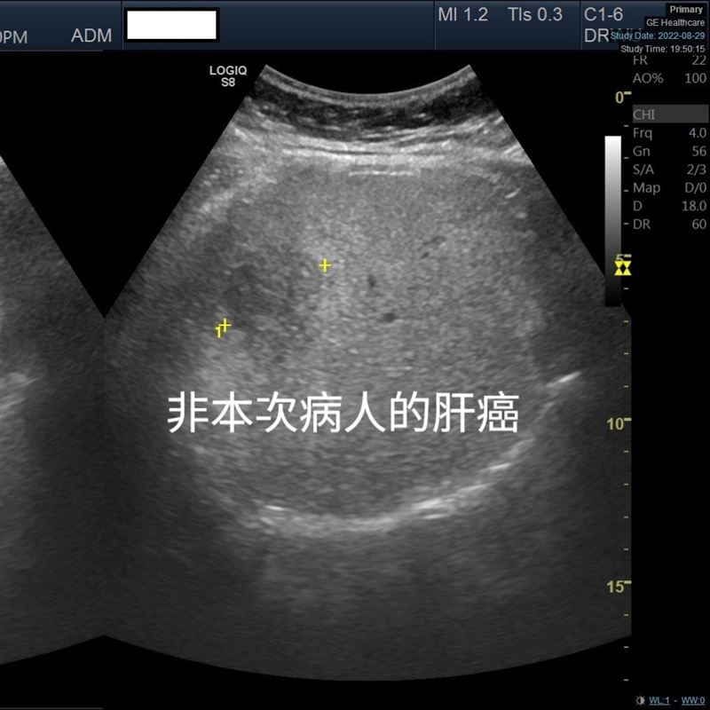 吳宗勤表示，45歲以上有肝硬化的患者需積極追蹤，定期回診觀察。（圖／翻攝自腹內的日常 吳宗勤醫師臉書）