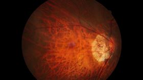 2歲以下別玩手機　醫曝「恐怖原因」,高度近視眼底, 併發黃斑部病變, 壢新醫院, 聯新國際醫院, 張文瑞,高度近視眼底, 併發黃斑部病變 眼睛 眼球