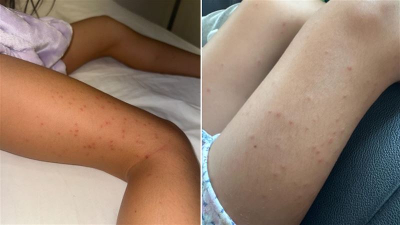 一位從日本來台旅遊的媽媽控訴，日月潭知名飯店有床蝨問題，她與孩子都被叮咬、全身奇癢。（圖／翻攝自爆料公社）