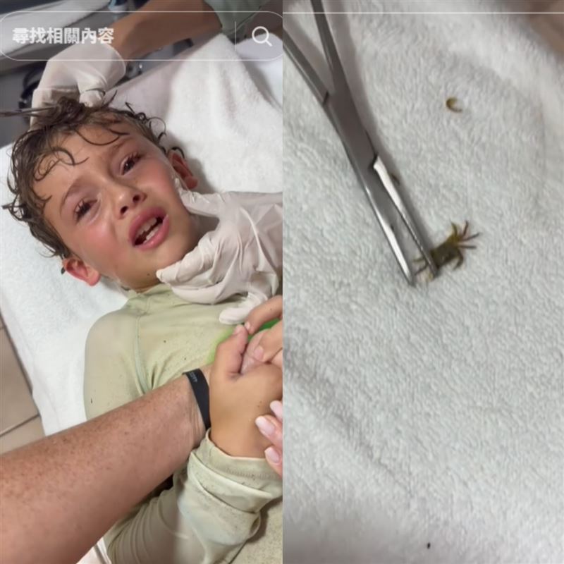 醫師檢查男童耳朵，結果竟夾出一隻活跳跳的小螃蟹。(圖／翻攝自TikTok＠kitziamitre)