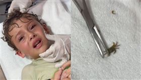 男童海邊玩，感覺耳朵癢癢，醫師夾出小螃蟹，I(圖／翻攝自TikTok＠kitziamitre)