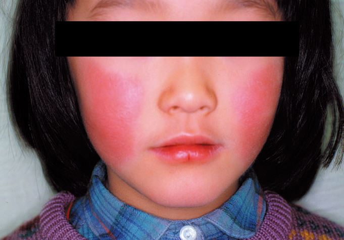日本沖繩爆發「蘋果病」疫情。（圖／翻攝自日本國立健康危機管理研究機構）