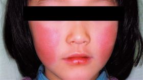 日本沖繩爆發「蘋果病」疫情。（圖／翻攝自日本國立健康危機管理研究機構）