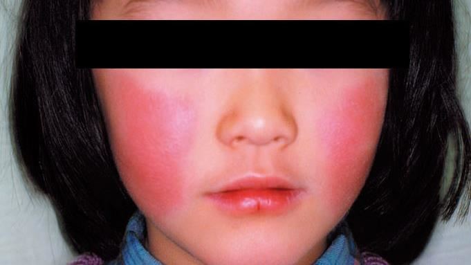 沖繩爆「蘋果病」！孕婦感染有流產風險