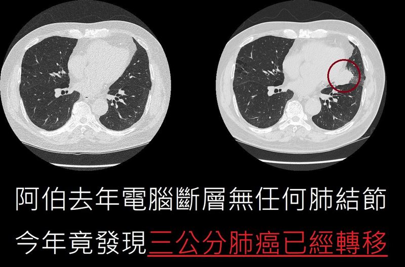 一名70多歲男子去年曾做電腦斷層，未發現肺結節等異常，今年再度檢查，竟已有3公分的肺癌及轉移，已是癌末。(圖／取自蘇一峰的臉書)