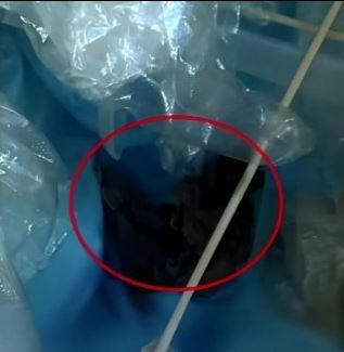 女子手術後，竟在20天後發現體內遺留一大塊紗布，沒想到醫生不僅否認疏失，還懷疑她「訛錢」