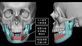 3D手術設計，結合個製化植入物重塑下顏面外型，腓骨皮瓣合併人工植牙口腔重建。（圖／北榮提供）
