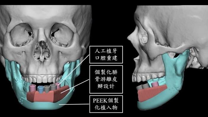 下顎骨手術切除　1技術咀嚼、外觀全恢復