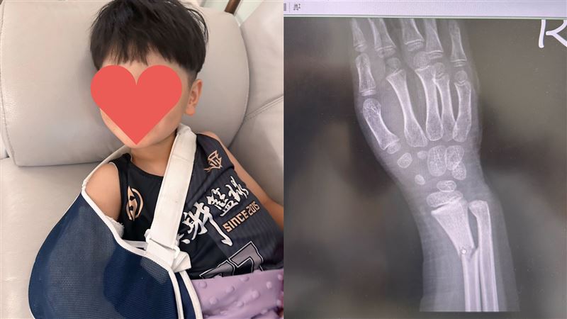 白家綺6歲兒子受傷骨折。（圖／翻攝自白家綺臉書）
