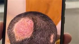 6歲弟頭長膿癬禿了！元凶是「可愛寵物」