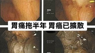 胃痛拖半年！35歲女癌細胞擴散整個腹腔