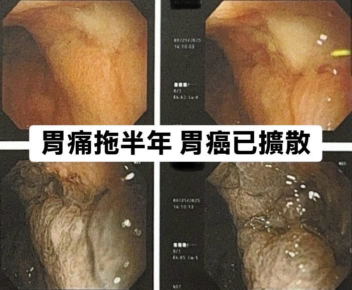 林相宏表示，胃癌有15%機率發生在年輕族群，建議高風險族群提早就醫檢查。（圖／翻攝自林相宏醫師臉書）