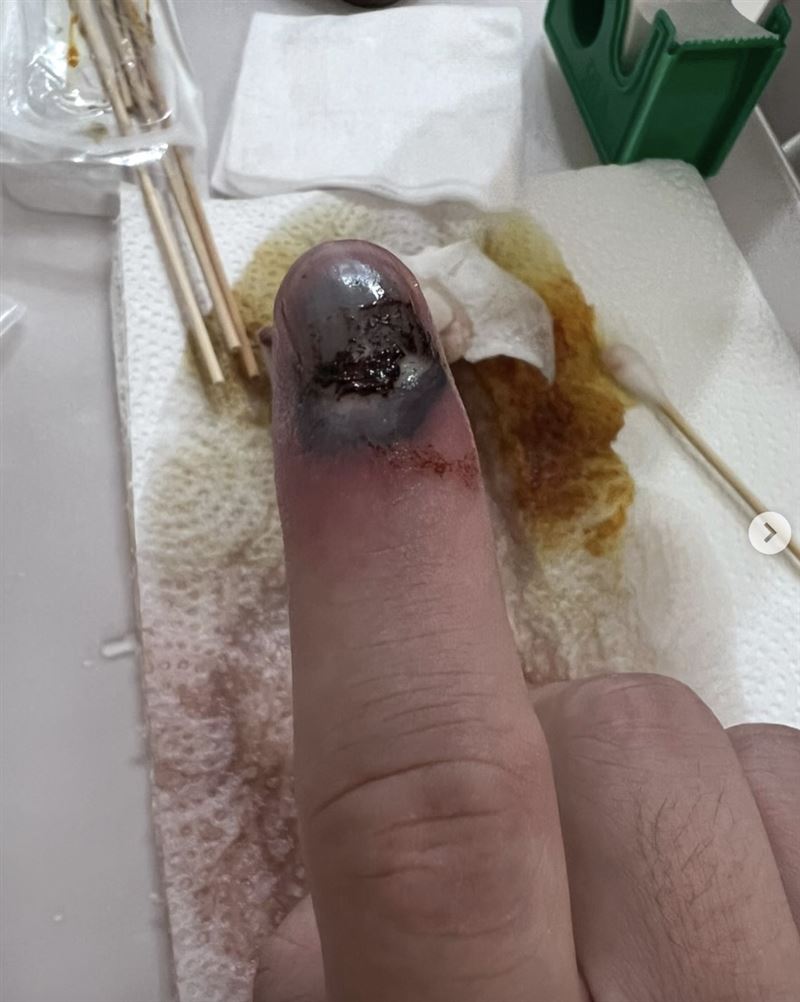 閩南狼透露自己手被夾斷。（圖／翻攝自IG）