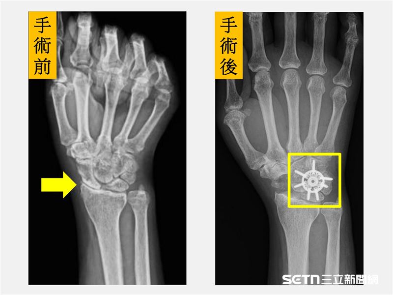 圖左：術前X光顯示舟橈關節炎及舟月骨間隙增大（箭頭處）；圖右：術後X光顯示舟狀骨切除並以環狀鋼板固定部分腕骨（方框處）。（圖／院方授權提供）
