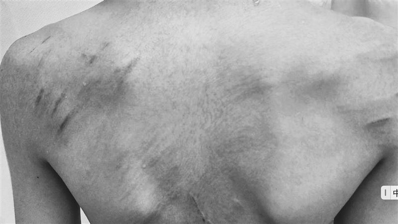 國中男遭同學痛毆全身傷　母控校方冷處理