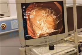 10歲女肚子痛3年　胃塞滿頭髮清出2大盆（圖／微博）