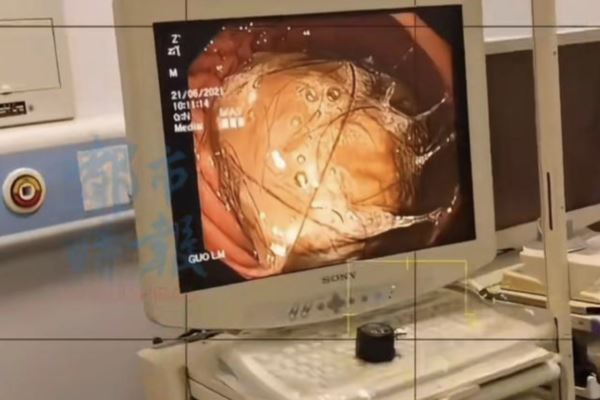 10歲女肚子痛3年　胃塞滿頭髮清出2大盆