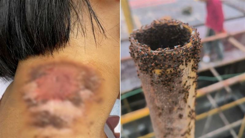 4歲女兒上月10日不慎沾染隱翅蟲毒液，脖子當天就紅了一圈、長出水泡潰爛，即使25天過去，目前仍未痊癒，留下明顯疤痕。（圖／翻攝極目新聞）