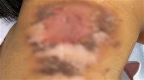 王女士的四歲女兒因誤沾隱翅蟲毒液導致嚴重皮炎。（圖／翻攝自極目新聞）