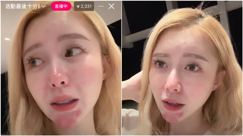 饅頭媽因懷孕爛臉。（圖／翻攝自IG）
