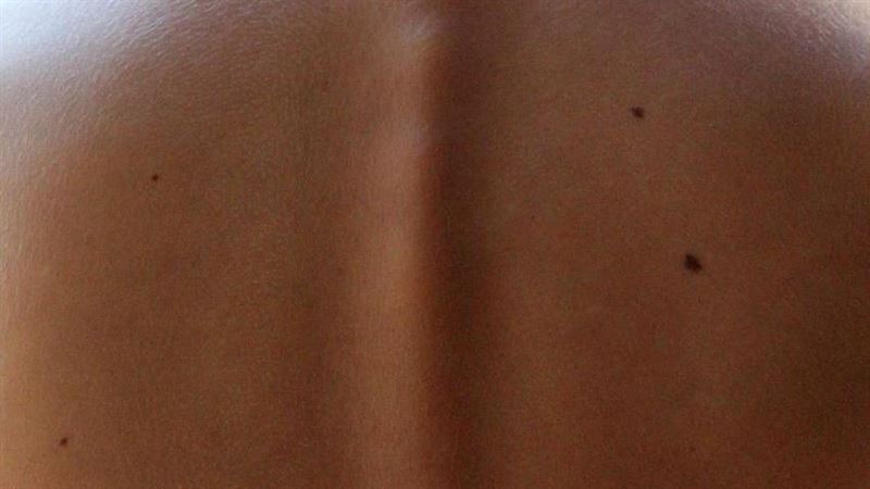 一名60歲男子發現,在短短半年內,他的胸、背部冒出大量老人斑,原以為只是老化,檢查才知是早期胃癌警訊。(示意圖/翻攝自pixabay)