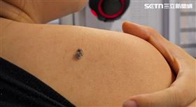 點痣,黑痣,痣,長痣,黑色素癌。（圖／資料照）