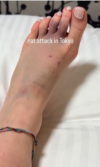 Tutku被老鼠咬的腳背發黑,齒痕清晰可見,連醫生都嚇了一跳。(圖/翻攝自IG@yogitutty)