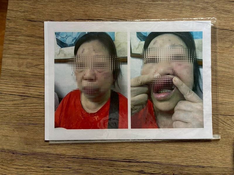 模範母親阿芸姨獨力照顧精障女兒慘遭惡少毆打斷牙，求救無門哭斷腸。圖為阿芸姨被惡少打得鼻青臉腫，牙齒斷3顆。（圖／《愛的延續》公益協會提供）