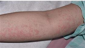 成大醫院,皮膚部,楊省三,史迪爾氏症

發高燒時，不癢的鮭魚色斑丘疹出現在病人的四肢與軀幹。
圖／翻攝自成大醫院臉書

