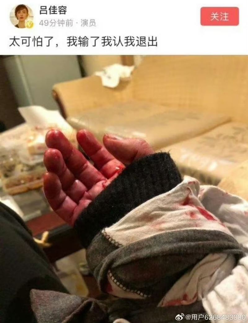 呂佳容消失前曾貼出血手照。（圖／翻攝自微博）