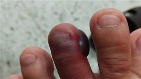 腳趾被馬陸咬，腫成可麗露（圖／翻攝自當事人臉書）