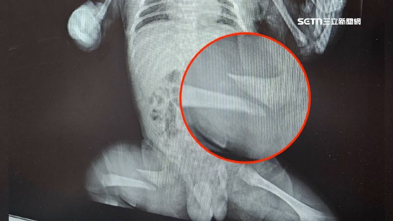 送醫後發現男嬰右大腿骨頭斷裂