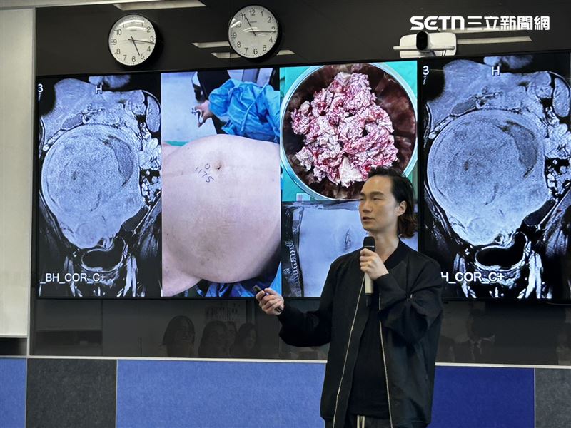 患者持續忍受腹脹、反覆經血過多與貧血的困擾,2年後再次就診檢查時,才發現子宮已達28公分。(圖/記者簡浩正攝影)