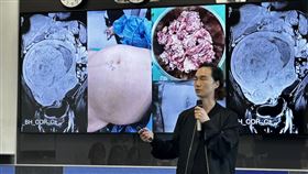 患者持續忍受腹脹、反覆經血過多與貧血的困擾，2年後再次就診檢查時，才發現子宮已達28公分。（圖／記者簡浩正攝影）