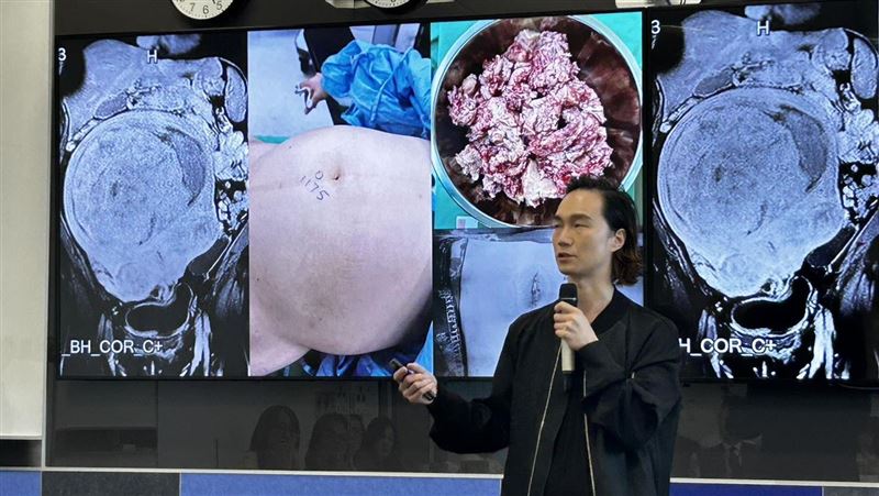 腹脹、貧血竟忍2年！婦子宮肌瘤大如籃球