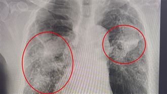 70歲翁染A流併發肺炎　肺白掉一半險喪命