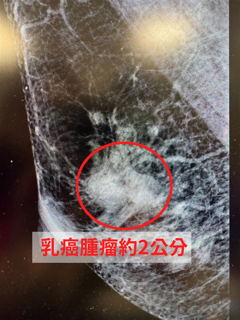 60歲婦人右側乳頭濕疹時好時壞、發紅滲液,確診乳癌2期。(圖/中醫大新竹附醫提供)