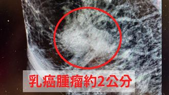 乳頭濕疹3個月沒好　竟是癌症第2期