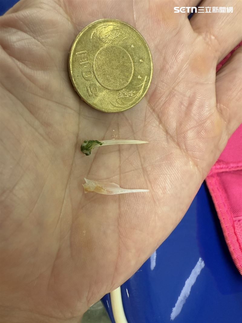 男主管吃東西喝口水都感到胸口刺痛,忍了半天受不了自行掛急診,醫師一度以為是心肌梗塞或主動脈剝離,結果發現是兩根魚刺作祟。(圖/翻攝畫面)